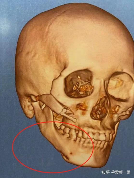 脸颊左右两边的突出的部位称为颧骨。西医解剖学这样介绍
